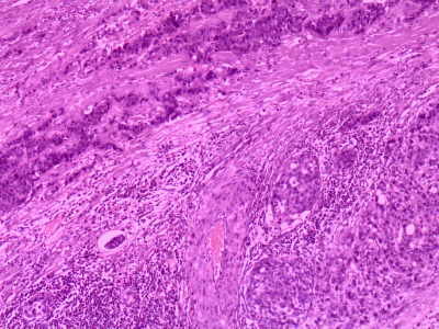 Litiasis de Vesícula Biliar y Adenocarcinoma. 