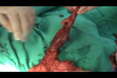 Video de espécimen quirúrgico, observando el esófago el fondo y parte de la neoplasia. Cáncer de Barrett