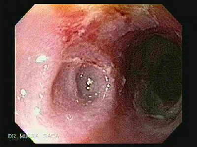 Endoscopy of Severe Reflux Esophagitis.