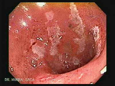 The duodenal bulb has also multiple erosions.