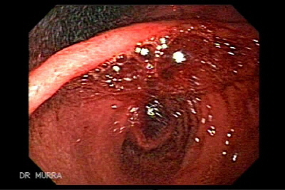ulcera del bulbo duodenal.