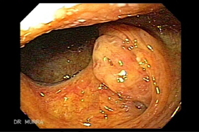 Neumatosis quistica intestinal