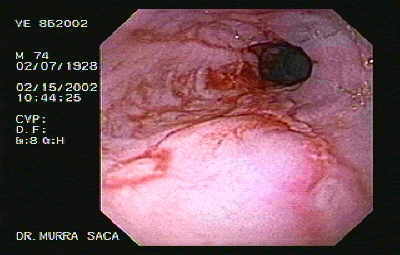 Endoscopy of Esophagitis and Stricture