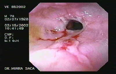 Esophagitis and Stricture.