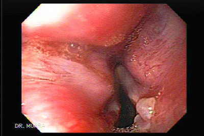 Laryngopharyngeal reflux (LPR).