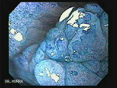 Endoscopy of Reflux Esophagitis