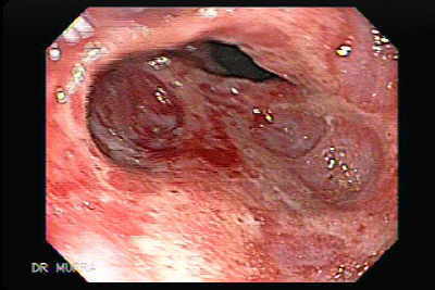 Severe Reflux Esophagitis and Hiatal Hernia