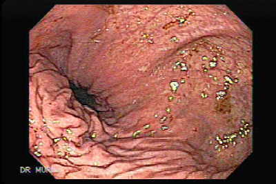 The image and the video clip display a large hiatus hernia