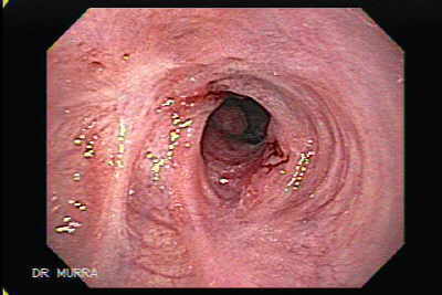 Stricture of the gastroesophageal Junction due to