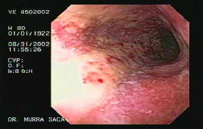 Hemorrhagic Esophagitis.