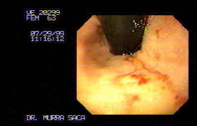 Ulcer caused by gastroesophageal reflux.