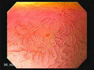 Gastroenetrologo San Miguel