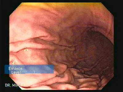 Gastroenetrologo San Miguel