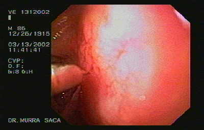 Gastroenetrologo San Miguel