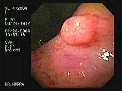 Ulcera Gástrica Gigante