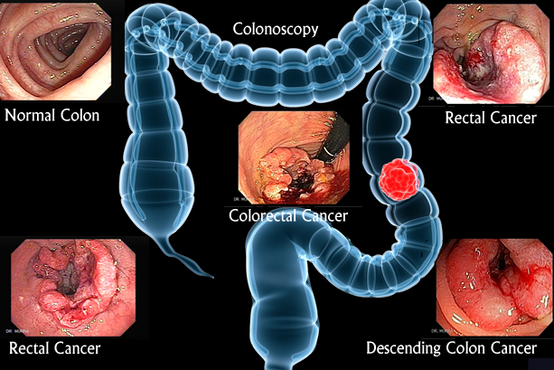 Polyps of the colon