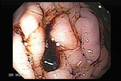 Ulceración de Dieulafoy