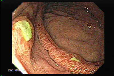 Gastritis Erosiva