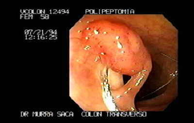 Polipectomia