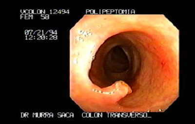 Polipectomia