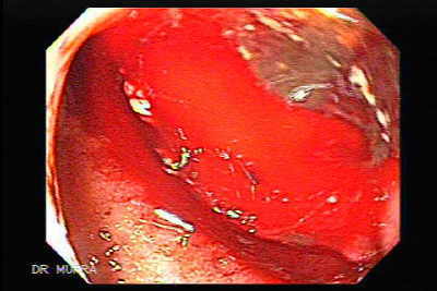 úlcera del bulbo duodenal.