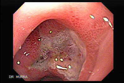 Ulcera Duodeno