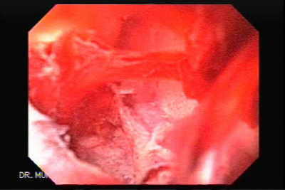 Ulcera duodenal sangrante