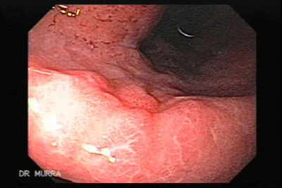 Ulcera Gigante.