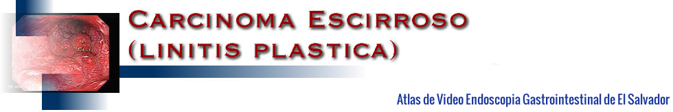 Endoscopia de Linitis Plástica