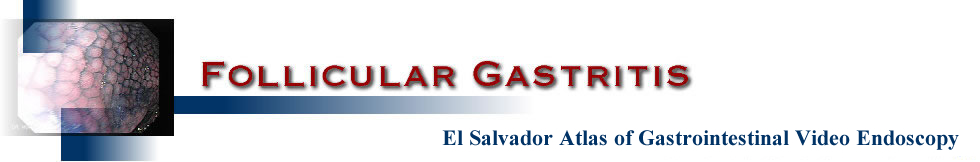 Follicular Gastritis