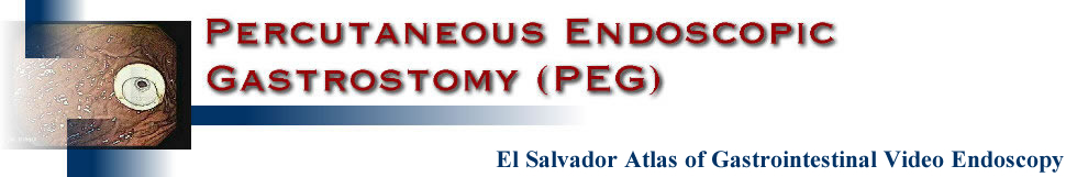 Percutaneous Endoscopic Gastrostomy