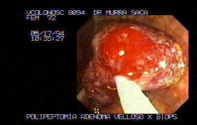 Polipectomia polipo